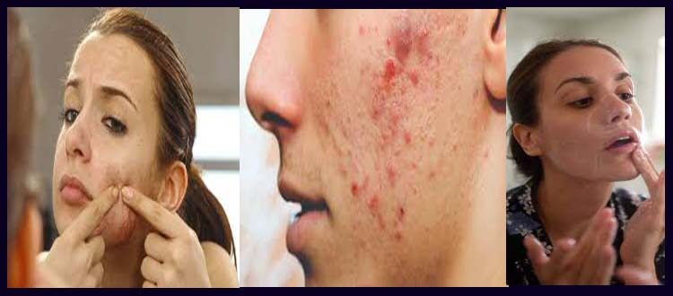 what causes pimples on the face