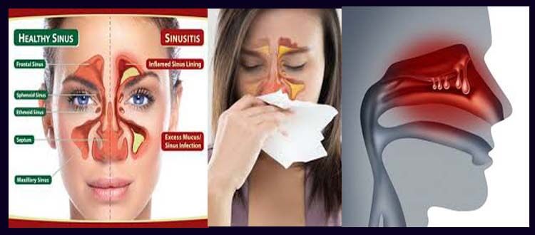 how to know if you have a sinus infection