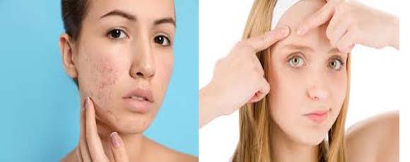How to treat acne and what is the best acne treatment?